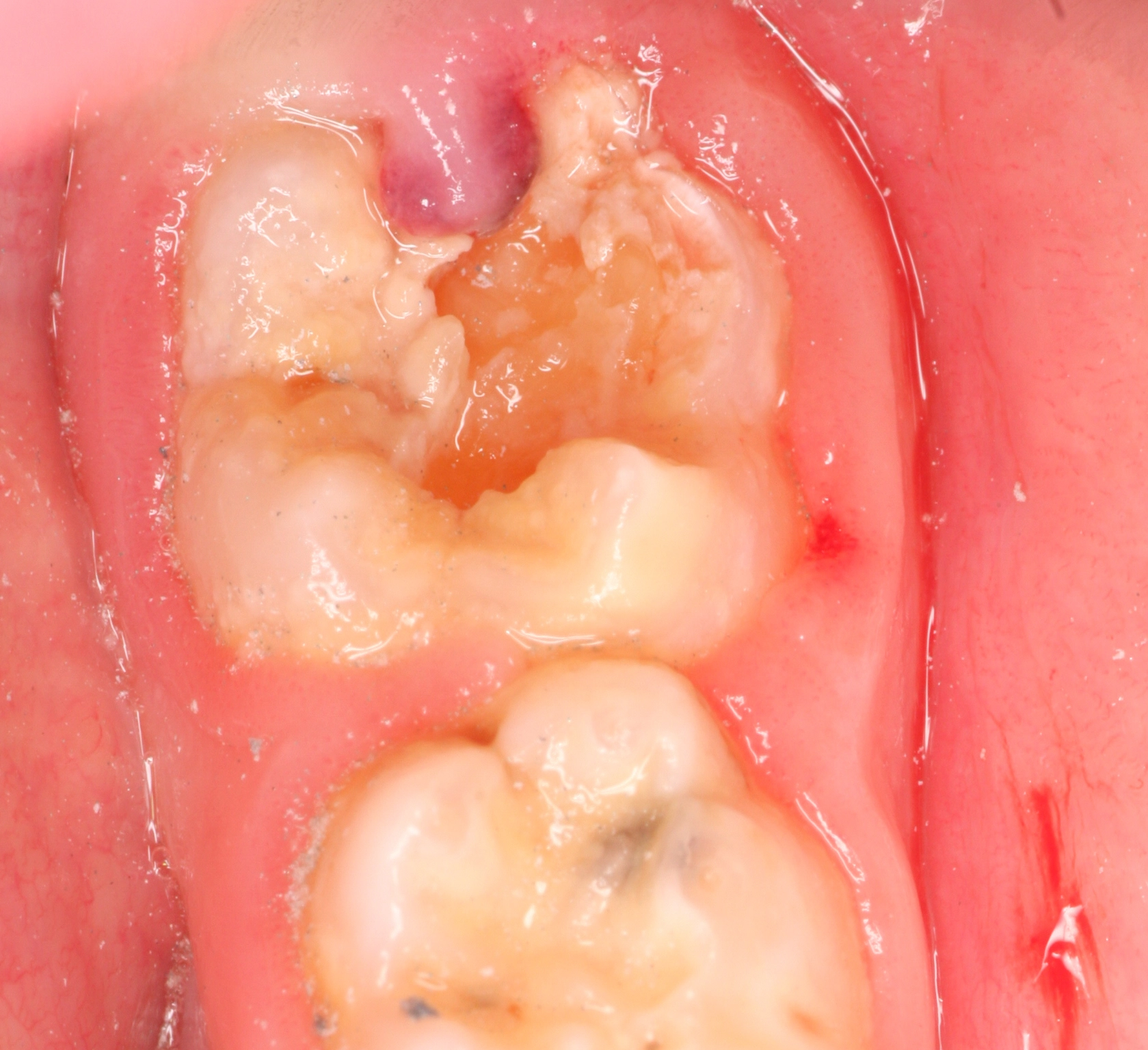 Abb. 4: Molaren-Inzisiven-Hypomineralisation Schweregrad 3.