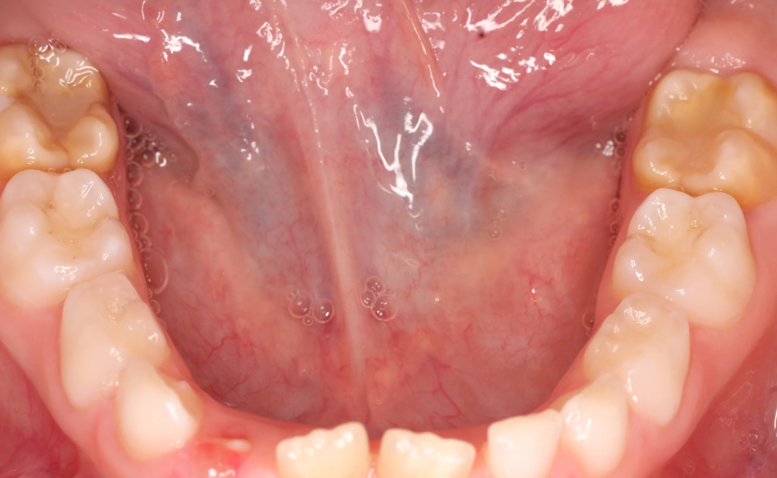 Abb. 5: Kompositfüllung an beiden MIH-Molaren.