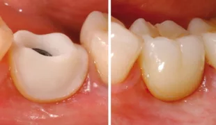 Hybrid-Abutment mit Emergenzprofil und Implantatkrone.