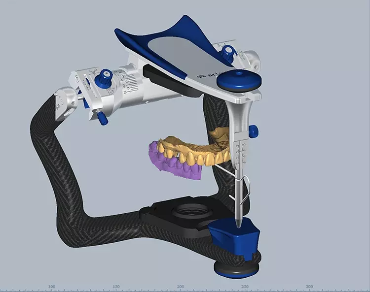 Abb. 1: Anhand der digitalen Gesichtsbogendaten virtuell einartikulierte Modelle.