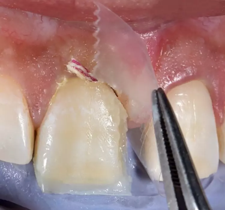 Abb. 10: Der geöffnete Bereich wurde mit Venus
Bulk Flow ONE aufgefüllt und der Streifen zur
Gestaltung der mesialen Kontur mit einer Pinzette
in die gewünschte Position gebracht.