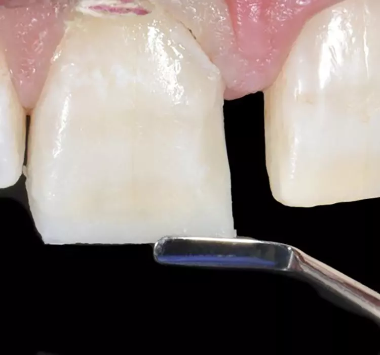 Abb. 11: Komposit Venus Pearl A2 wird in die Verschalung
(Abb. 8) eingebracht und an die Zahnoberfläche
im mesialen und inzisalen Bereich adaptiert.