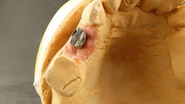 Abb. 12: Kompromisslösung der Implantatversorgung von Abb. 1 und 2.
