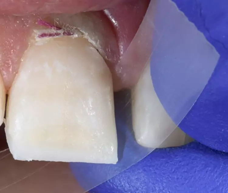 Abb. 12: Zur weiteren Gestaltung wird der Streifen
um den mesialen Bereich im Sulkus positioniert.