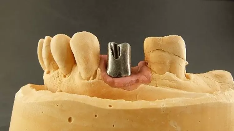 Abb. 13: Kompromisslösung der Implantatversorgung von Abb. 1 und 2.