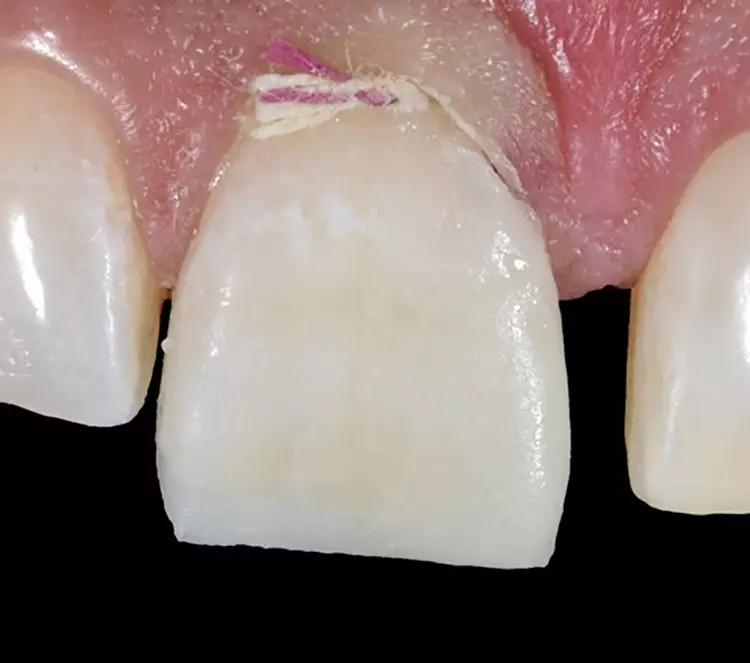Abb. 13: Nach Materialauftrag und Ausformung
der mesialen Kontur mittels Streifentechnik ist eine
runde, anatomisch adäquate Form entstanden.
