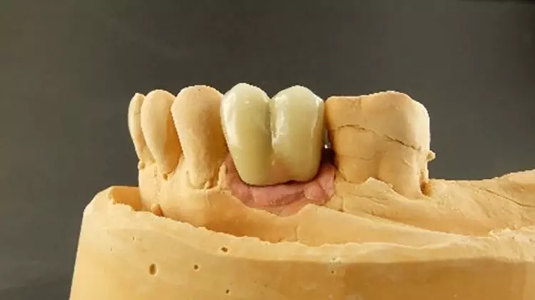 Abb. 14: Kompromisslösung der Implantatversorgung von Abb. 1 und 2.
