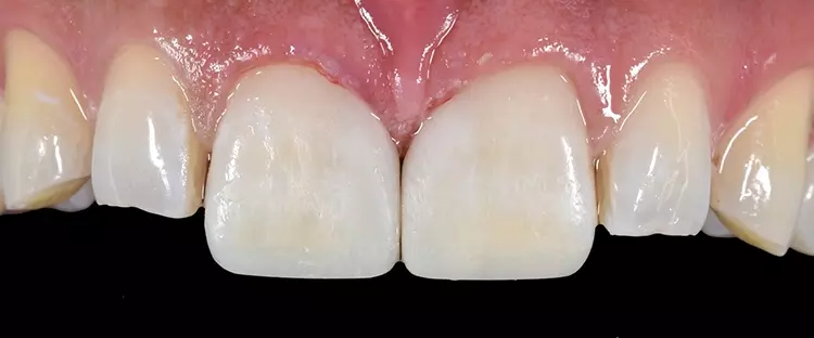 Abb. 14: Das geschlossene Diastema mediale.
Es sind natürlich proportionierte Zahnformen
entstanden. Die Papille hat eine natürliche Position
eingenommen