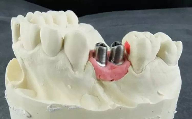Abb. 16: Als positiver Vergleich: Hier wurde bereits vor dem Setzen der Implantate abgesprochen, wie
die Platzsituation mit geeigneten Implantaten optimal zu lösen ist.