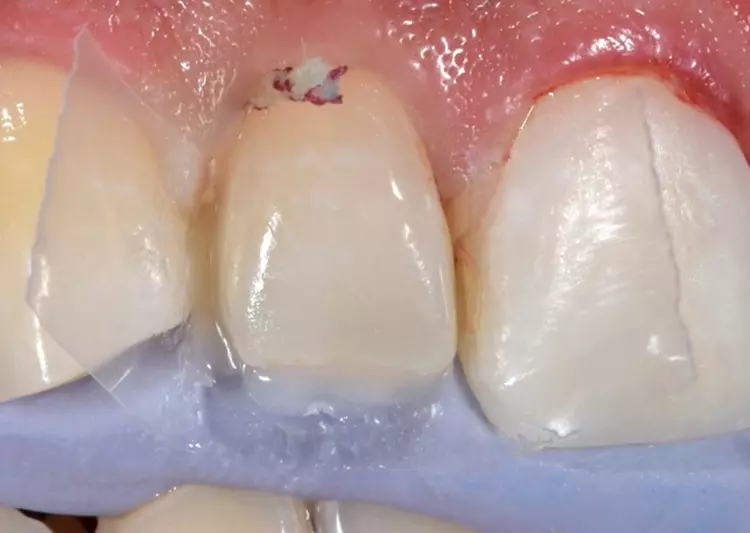 Abb. 15: Öffnung des distalen Korridors mit
passiver gingivaler Verdrängung durch den
Klarsichtstreifen.