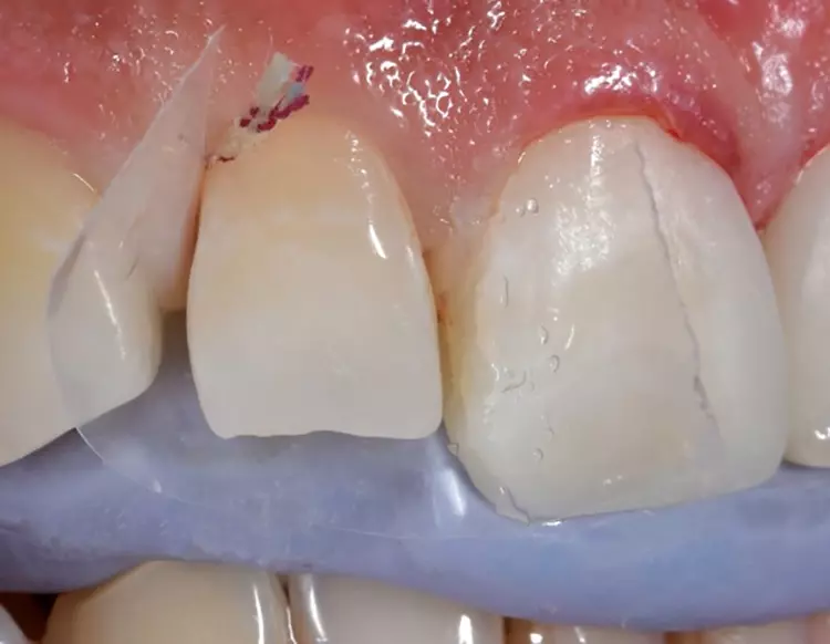 Abb. 16a: Der Streifen wurde mit der Sondenspitze
gegen den Silikonschlüssel gedrückt und Venus Bulk
Flow ONE in den geöffneten Bereich eingebracht.