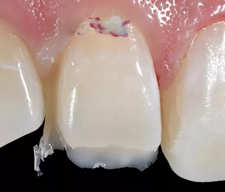 Abb. 16b: Nach Entnahme der Hilfsmittel
präsentiert sich ein stabiler Aufbau mit einem
primärem interdentalen Kontaktpunkt.