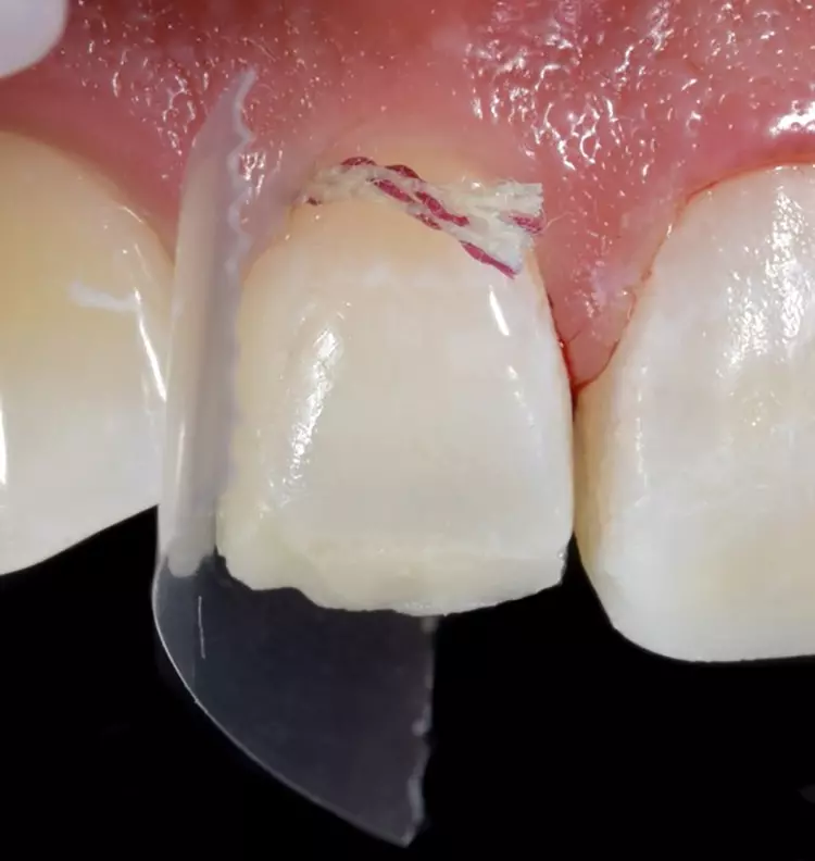 Abb. 17: Der Streifen wurde erneut interdental
positioniert und ein dentinfarbenes pastöses
Komposit (Venus Pearl OLC) formgebend aufgetragen.
Zur weiteren Gestaltung der distalen
Krümmung wurde ein helles schmelzfarbenes
Material aufgetragen und mittels Streifentechnik
konturiert.