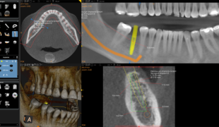Abb. 1: DVT-Anwendung in der präimplantologischen Planung zur Überprüfung der Knochensituation am
geplanten Implantationsort.