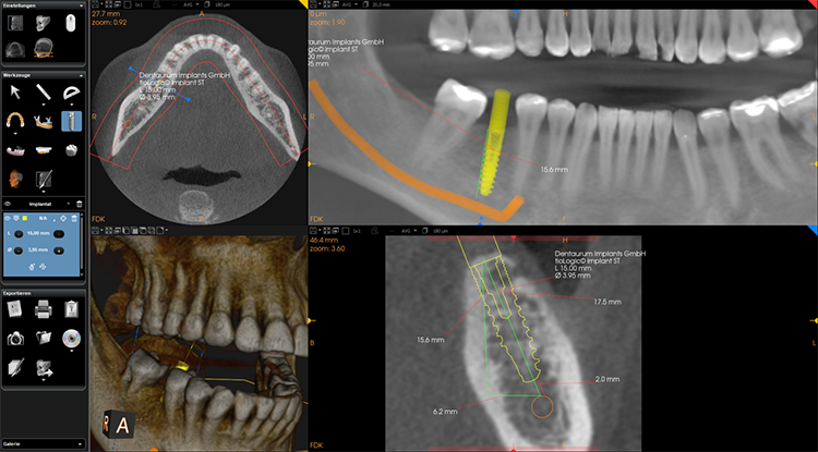 Abb. 1: DVT-Anwendung in der präimplantologischen Planung zur Überprüfung der Knochensituation am
geplanten Implantationsort.