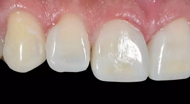 Abb. 18: Zustand direkt nach der Anfertigung und Entnahme der Retraktionsfäden.
Die gingivalen Verhältnisse sind unauffällig und wirken nach Gestaltung
des interdentalen Emergenzprofils wenig strapaziert.