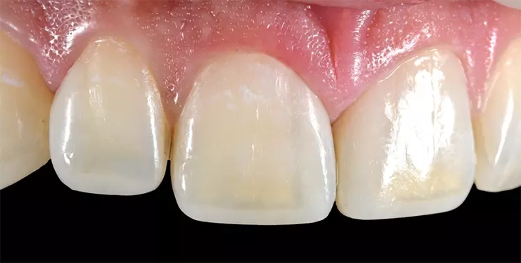 Abb. 19: Kontrolle nach 2 Wochen: Eine physiologische Integration in die gingivalen Strukturen wurde ermöglicht, das Gewebe hat sich reizlos adaptiert. Die
Proportionen untereinander sind ausgeglichen, die farbliche Anpassung ist jedoch insuffizient. Die Übergänge sind sichtbar und im inzisalen Drittel tritt die gelbliche
Dentinfarbe deutlich hervor.