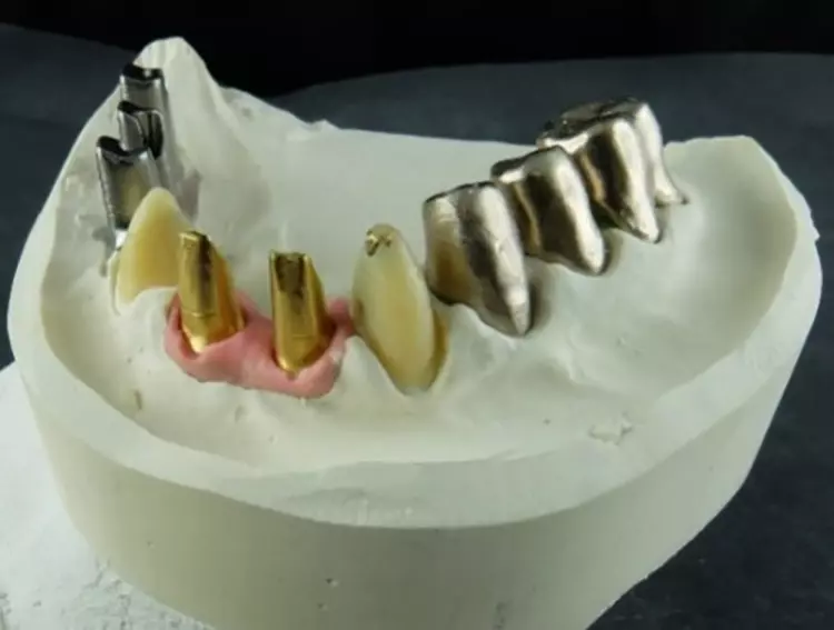 Abb. 23: Während der Therapie kamen weitere Implantate hinzu. Nach der Einheilphase und Erreichen
der stabilen Bisssituation konnte die prothetische Umsetzung begonnen werden.