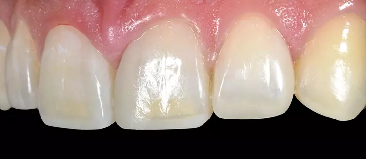 Abb. 20: Kontrolle nach 2 Wochen: Eine physiologische Integration in die gingivalen Strukturen wurde ermöglicht, das Gewebe hat sich reizlos adaptiert. Die
Proportionen untereinander sind ausgeglichen, die farbliche Anpassung ist jedoch insuffizient. Die Übergänge sind sichtbar und im inzisalen Drittel tritt die gelbliche
Dentinfarbe deutlich hervor.