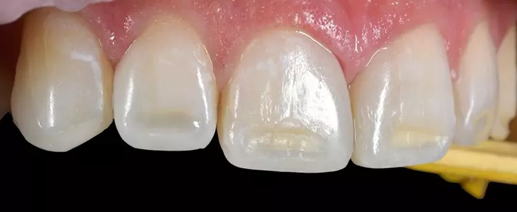 Abb. 21: Die ausgeschliffenen, farblich stark hervorgetretenen Areale. Eine Reduktion der Farbintensität ist zu erkennen. Ein Mundöffner wurde in Regio 23
platziert.