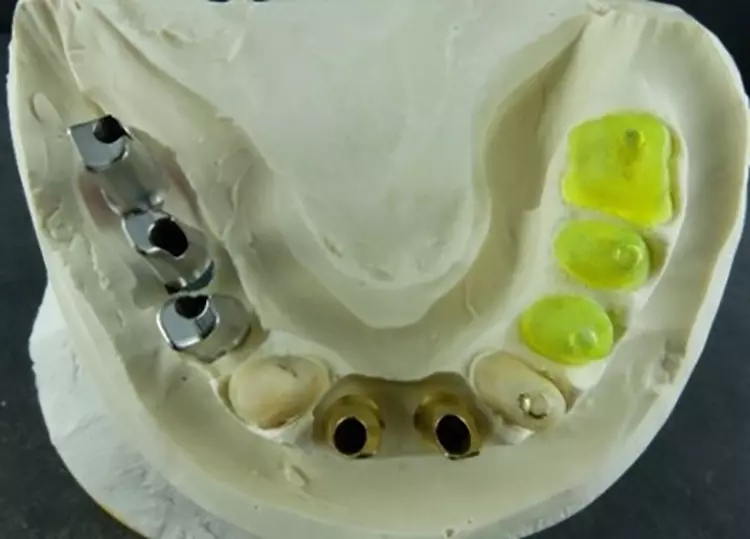 Abb. 24: Während der Therapie kamen weitere Implantate hinzu. Nach der Einheilphase und Erreichen
der stabilen Bisssituation konnte die prothetische Umsetzung begonnen werden.