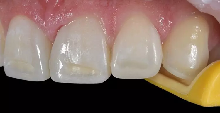 Abb. 22: Die ausgeschliffenen, farblich stark hervorgetretenen Areale. Eine Reduktion der Farbintensität ist zu erkennen. Ein Mundöffner wurde in Regio 23
platziert.