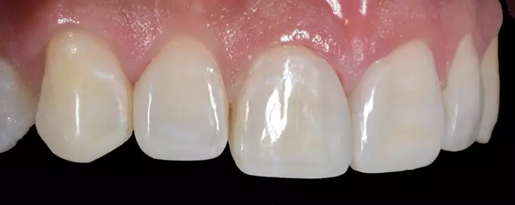 Abb. 25: Nach der Korrektur sind die farblich hervortretenden Merkmale reduziert.