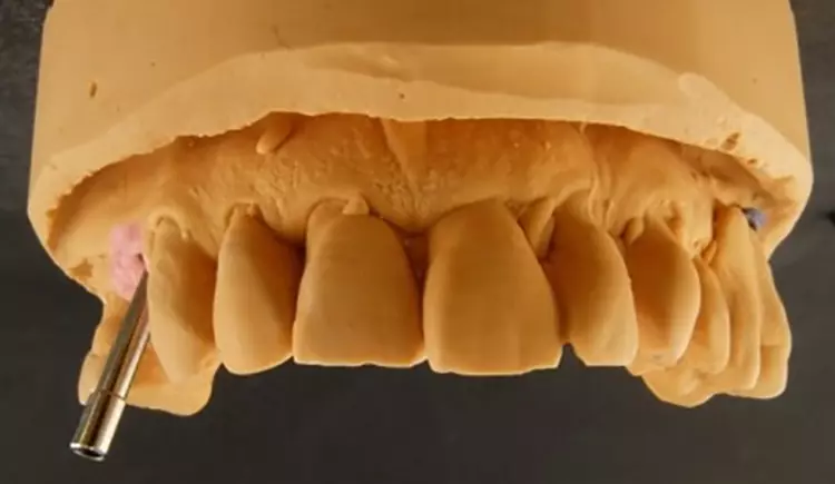 Abb. 2: Auch ein gut eingeheiltes Implantat
kann einen Misserfolg darstellen, wenn es an der falschen
prothetischen Stelle sitzt und dadurch keine langfristig
funktionierende Versorgung gewährleistet ist.