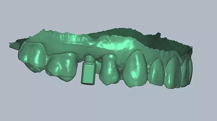 Abb. 3: Intraoralscan, bei dem lagerichtig zu der virtuell geplanten Implantatposition ein Scanbody auf dem Scan zu sehen ist.