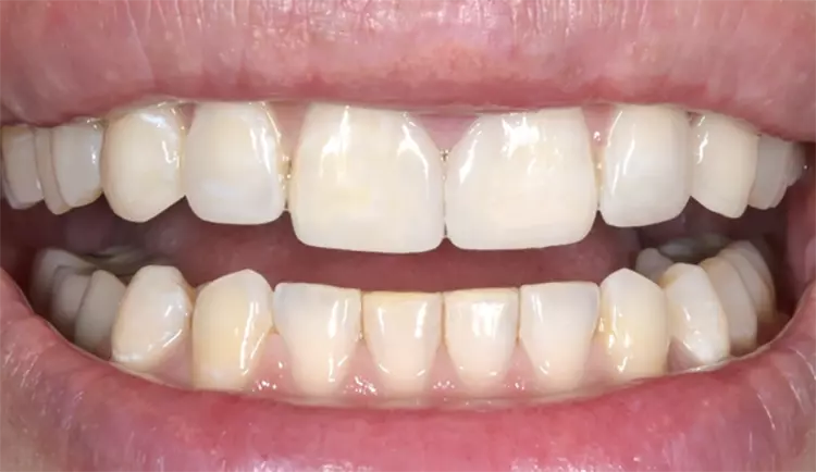 Abb. 28: Die Integration in den Restzahnbestand.