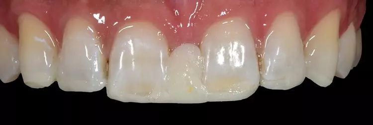 Abb. 4: Herstellung des Mock-up (Frankfurter Verschalung).
Interdental werden die Lücken geschlossen.
Die Zahnlänge wird mit einer durchschnittlichen
Länge von 10 bis 12 mm gestaltet und die
lateralen Schneidezähne proportionsgemäß angepasst.
Die Eckzähne werden palatinal aufgebaut
und nach inzisal verlängert.