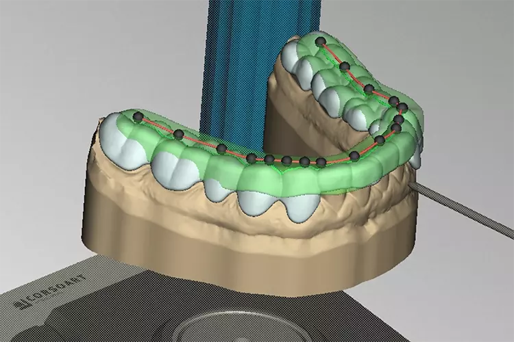 Abb. 4a: Adjustierungswälle mit einer Eckzahnführung