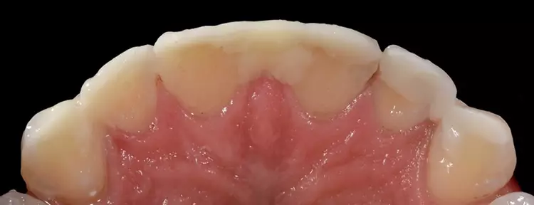 Abb. 5: In der Ansicht von palatinal wird der
Lückenschluss so gestaltet, dass die spätere
Konstruktion der Flächen- und Formbestandteile
erleichtert wird.