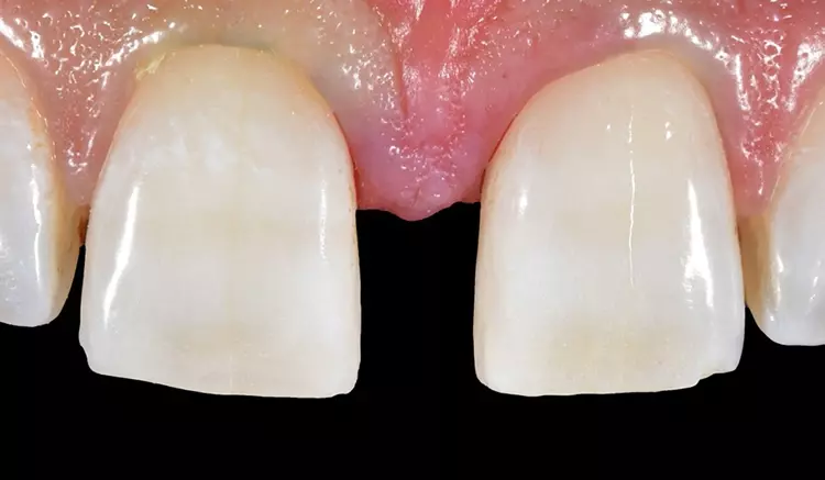 Abb. 6: Nach Legen des Retraktionsfadens der
Stärke II wird die Zahnoberfläche an 11 im mesialen
und inzisalen Drittel mit Pulverstrahl (50 μm)
gereinigt. Insuffiziente Schmelzanteile sowie
kolorierte Impaktierungen werden entfernt.