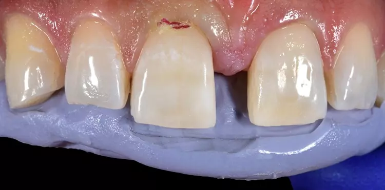 Abb. 7: Der Silikonschlüssel wird auf spannungsfreien
Sitz überprüft und die Gestaltungsmöglichkeit einer
dreidimensionalen Zahnstruktur im mesialen Bereich
beurteilt.