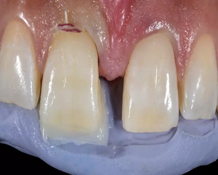 Abb. 8: Dentinfarbenes, opakes Komposit
(Venus Pearl OLC) wird gemäß den Vorgaben
des Mock-ups in Position gebracht.