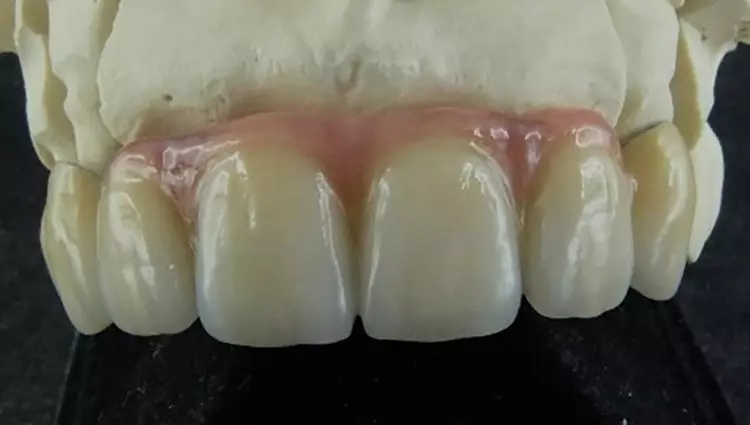 Abb. 9: Die Frontzahnbrücke musste nochmals neu angefertigt werden. Wieder mit einem Metallgerüst, aber diesmal vollverblendet mit minimalen Girlanden palatinal
als Verstärkung. Nachdem ich darauf bestanden hatte, mit der Patientin direkt zu sprechen, teilte sie mir noch ihre Änderungswünsche in Bezug auf eine hellere
Farbe, Form und Gingivagestaltung mit. Leider war das „Kind schon in den Brunnen gefallen“ und die Frage nach den Kosten der Neuanfertigung stellte sich!