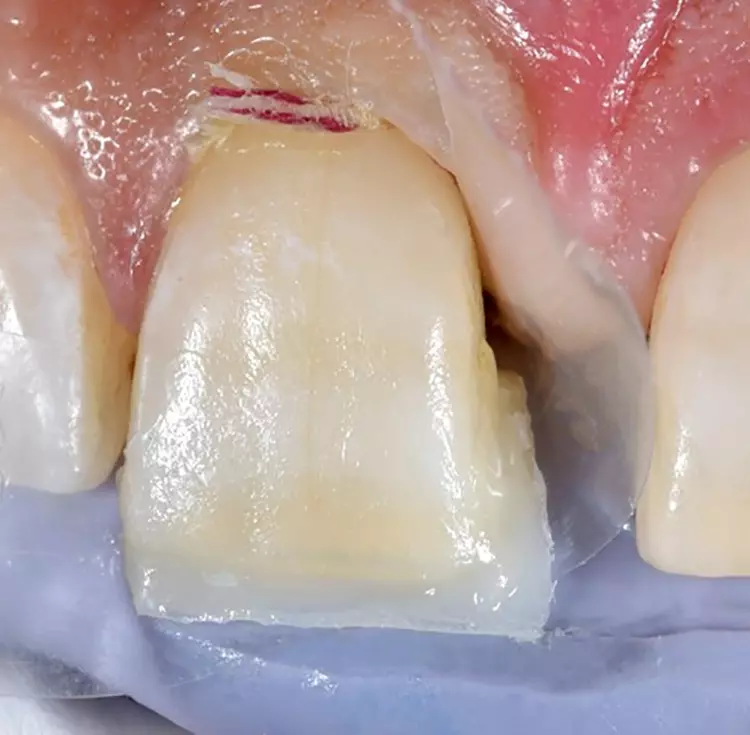 Abb. 9: Ein Klarsichtstreifen wird im Sulkus positioniert.
Eine Verdrängung der mesialen Papille ist sichtbar.
Eine Öffnung des subgingivalen Bereichs ist
ebenfalls erfolgt.