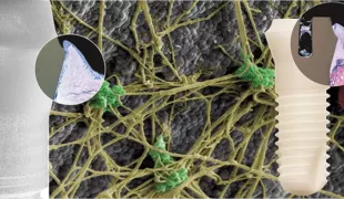 Abb. 1: Durch Blutgerinnung bildet sich innerhalb von Minuten nach der Insertion ein Fibrinnetzwerk an der Oberfläche des Patent™ Implantats.