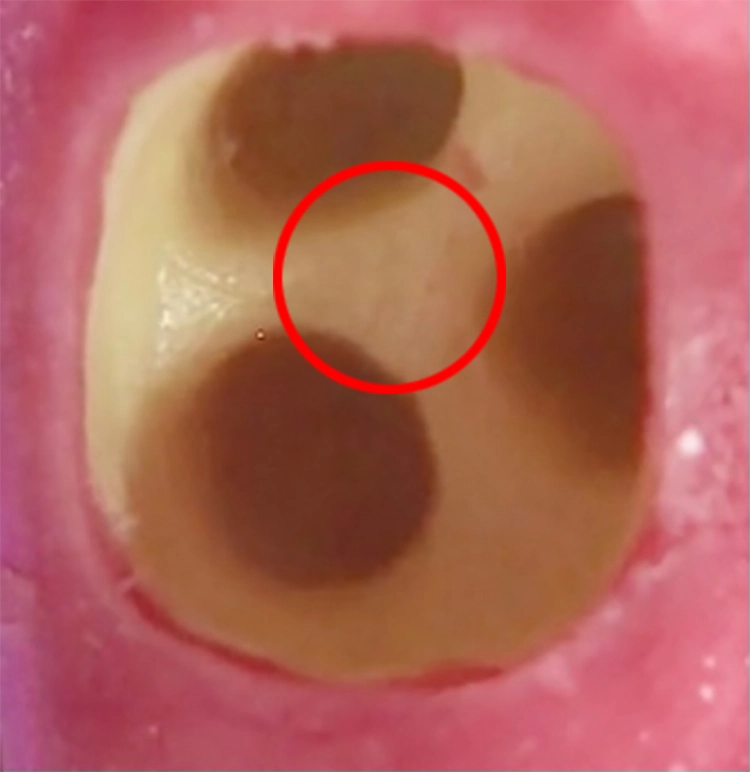 Abb. 3: In dieser Trifurkation wird ein Implantatbett geschaffen.