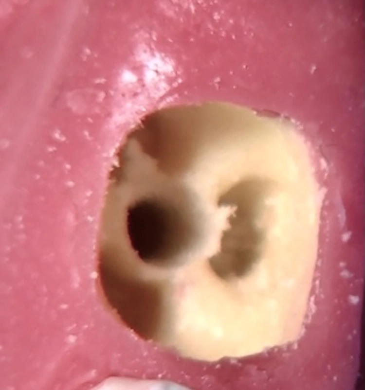 Abb. 6: Das aufbereitete Implantatbett.