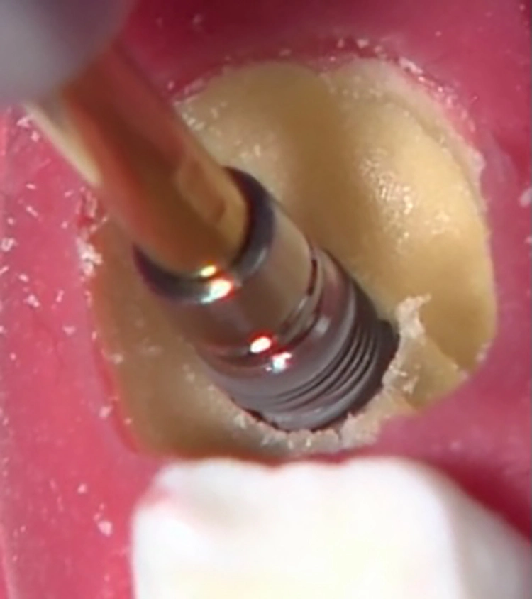 Abb. 7: Insertion eines Champions (R)Evolution Implantats.