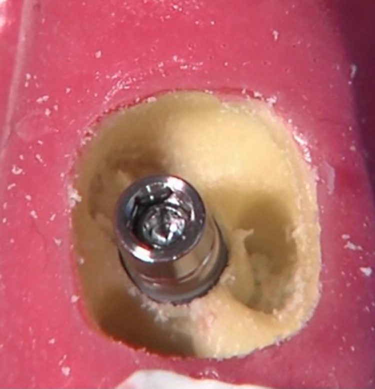 Abb. 8: Das subkrestal inserierte Implantat.