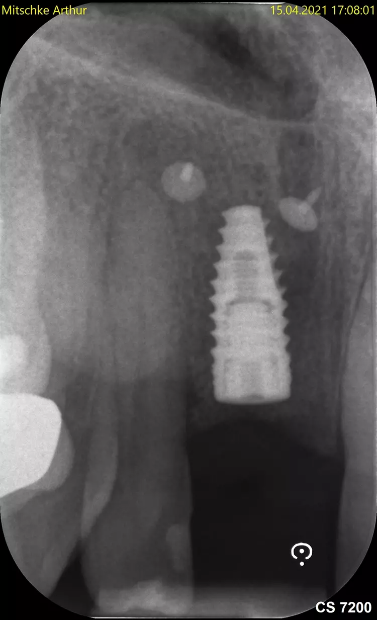 Abb. 11: Röntgenkontrollbild des Implantates.