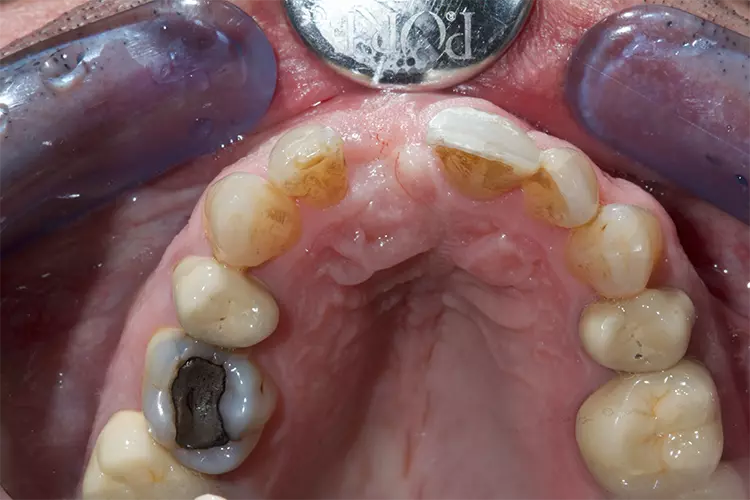 Abb. 12: Ansicht von okklusal vor Freilegung nach 5-monatiger Einheilphase.