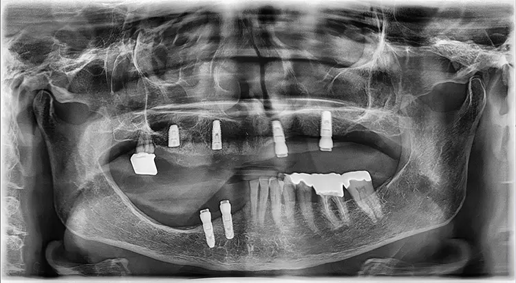 Abb. 12: Postoperatives Orthopantomogramm nach Implantation regio 14 und
16.