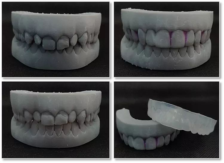 Abb. 12: Gedruckte STL-Dateien prä/post Aligner-Therapie und Smiledesign mit Präp-Guide.