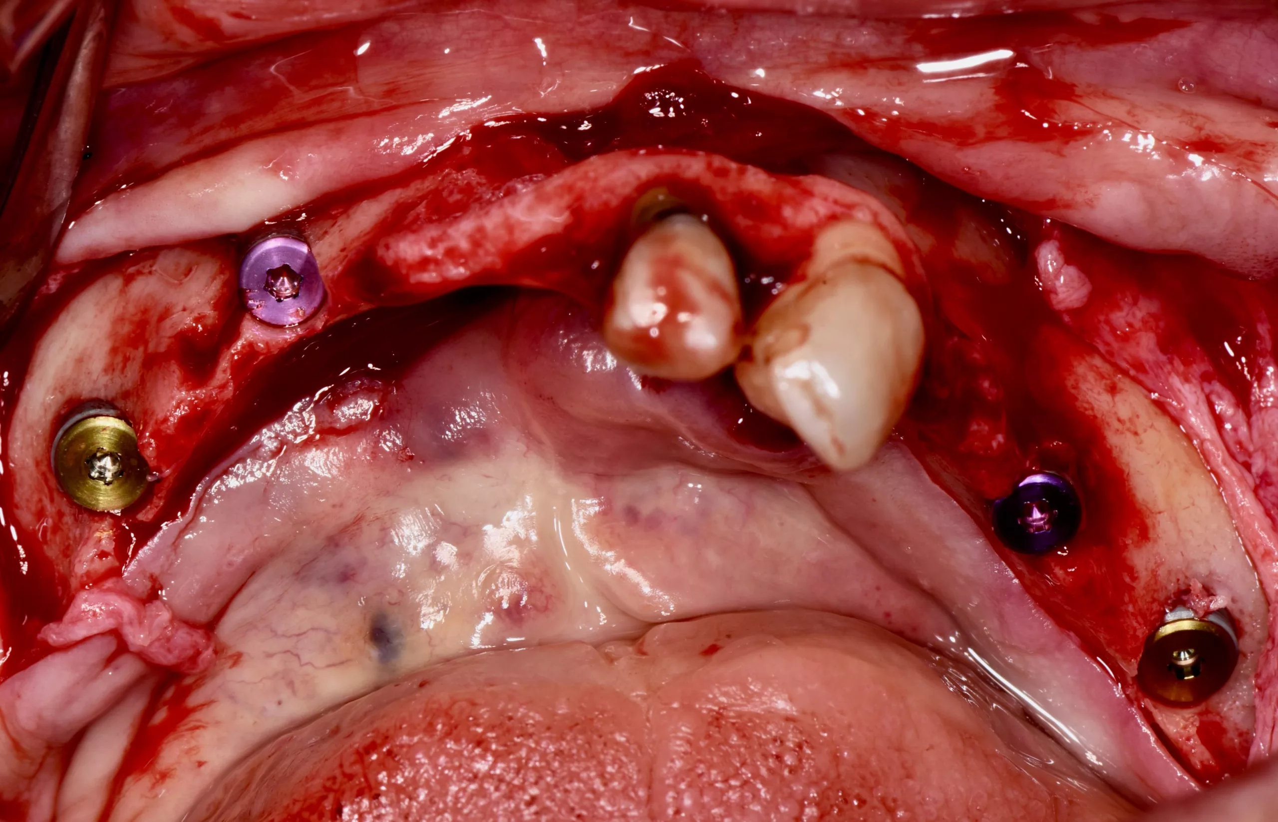 Abb. 13: Inserierte Implantate.