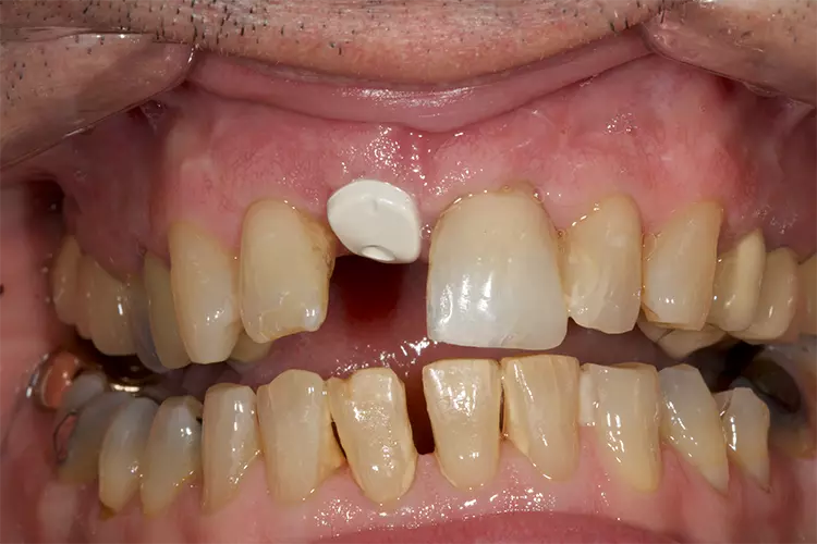 Abb. 14: Ansicht des individuellen PEEK-Gingivaformers.