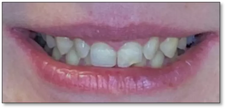 Abb. 14a: Ausgangsituation und Endsituation mit 360°-Veneers in situ.